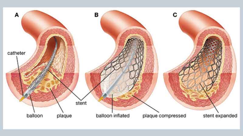 Cardiac catheterisation